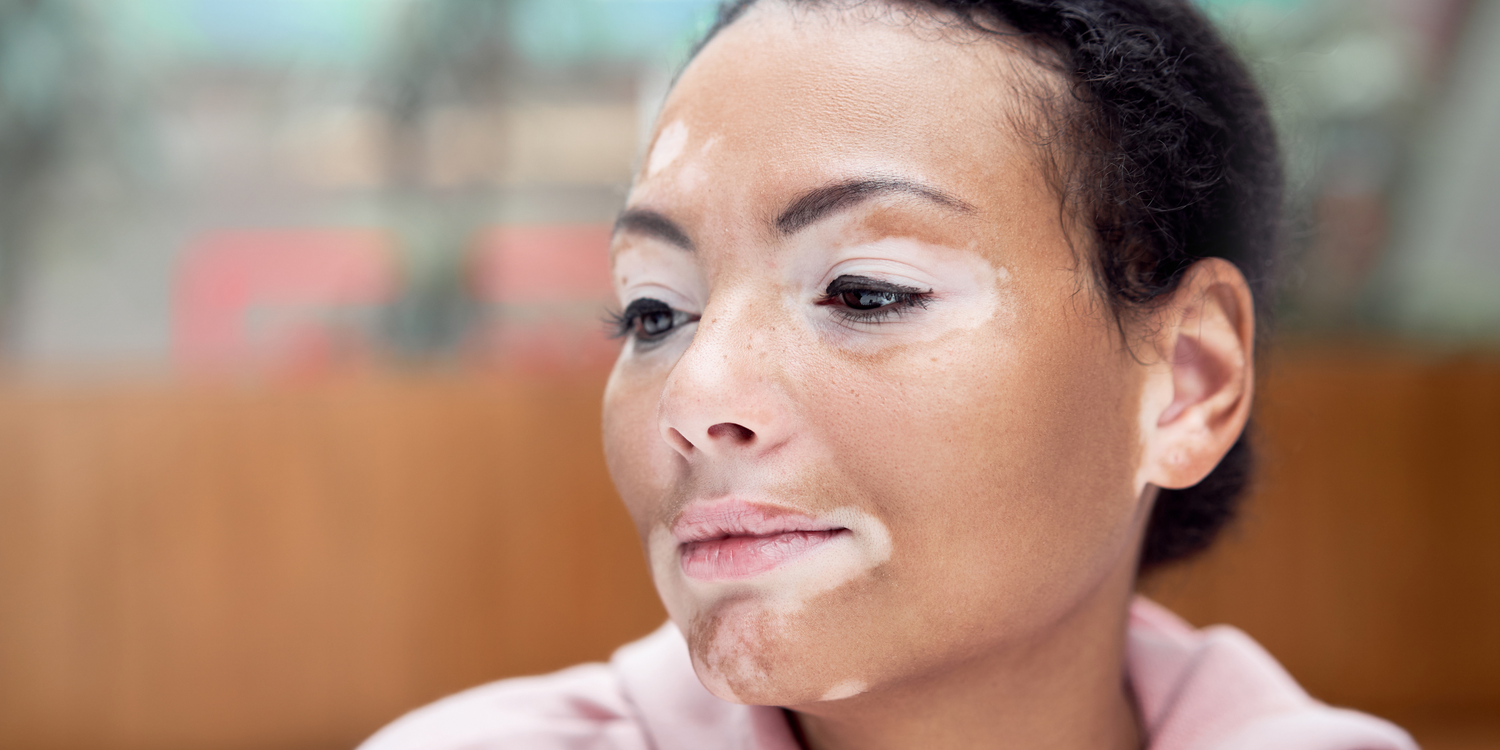 Safed Daag Ka Ilaj: Ayurvedic, Gharelu aur Modern Upay