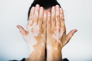 Treatment for Vitiligo